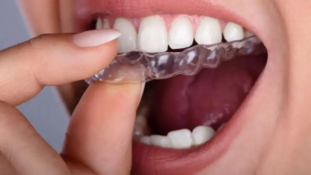 Conoce los 4 tipos de ortodoncia en nuestra clinica dental