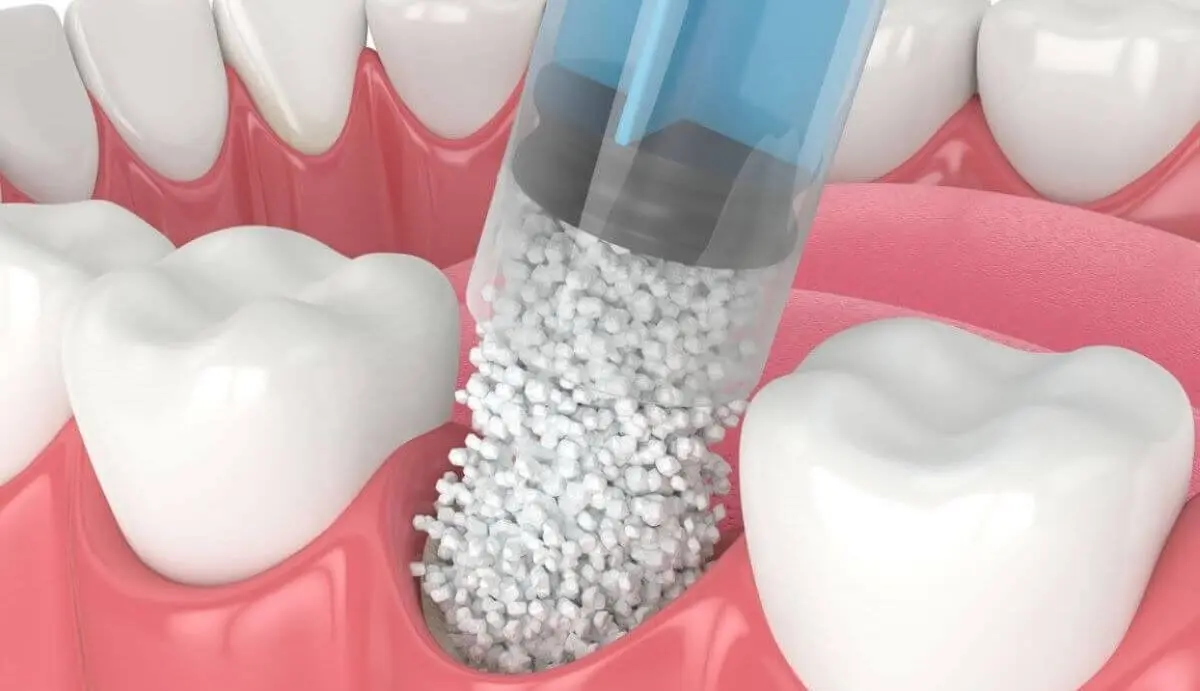 Implante dental y elevación de seno maxilar