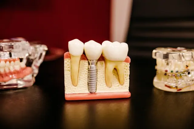 Pérdida de dientes y sus tratamientos estéticos